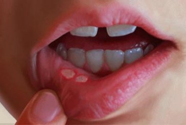درمان آفت های دهانی با طی سنتی
